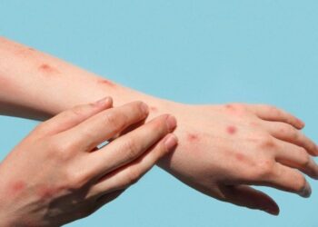 Varíola dos macacos se torna emergência global