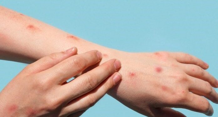 Varíola dos macacos se torna emergência global