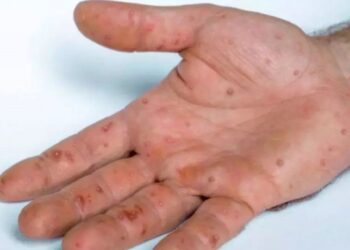 Varíola dos Macacos: confirmado primeiro caso em Itaperuna