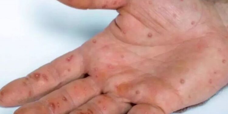 Varíola dos Macacos: confirmado primeiro caso em Itaperuna