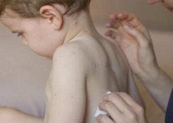 Criança de dois anos testa positivo para varíola dos macacos em Araruama