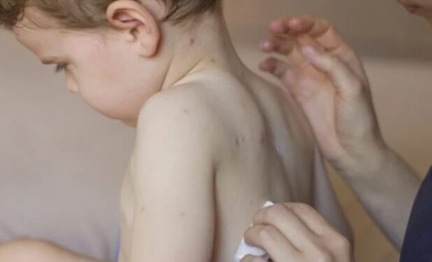 Criança de dois anos testa positivo para varíola dos macacos em Araruama