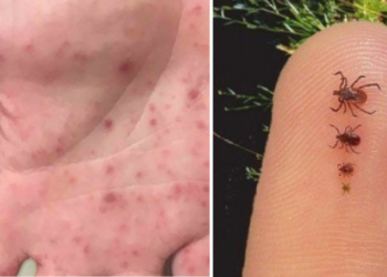 Estado confirma morte de menino de 10 anos por febre maculosa em Campos