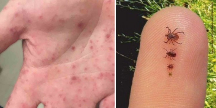 Estado confirma morte de menino de 10 anos por febre maculosa em Campos