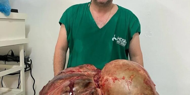 Tumor com cerca de 46 kg é retirado de mulher em cirurgia de emergência em Itaperuna