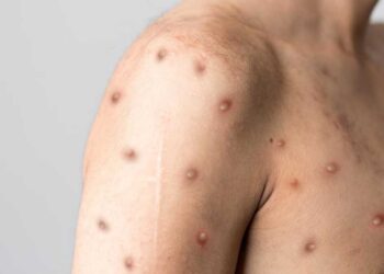 Macaé registra primeiro caso de varíola dos macacos