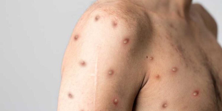 Macaé registra primeiro caso de varíola dos macacos