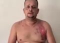 Homem que ateou fogo na namorada é preso em Campos