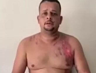 Homem que ateou fogo na namorada é preso em Campos