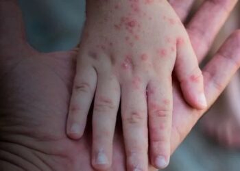 Caso suspeito de mpox é investigado em São Pedro da Aldeia
