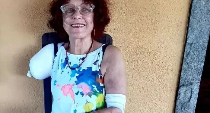 Justiça determina que Prefeitura de Saquarema e Governo do Estado do Rio paguem prótese biônica para Roseana Murray
