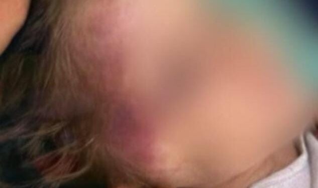 Justiça decreta prisão preventiva de homem acusado de torturar enteada de três anos