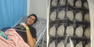 Aluno autista sofre fratura e família denuncia agressão em escola